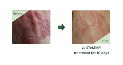 Improved skin soothing effect after 2 weeks of use