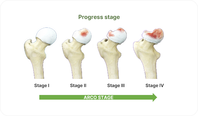 Osteonecrosis of the Femoral Head (Avascular necrosis)