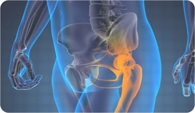 Osteonecrosis of the Femoral Head (Avascular necrosis)